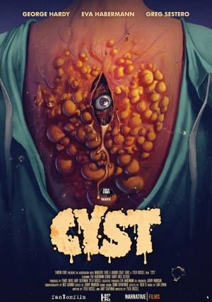 Cyst